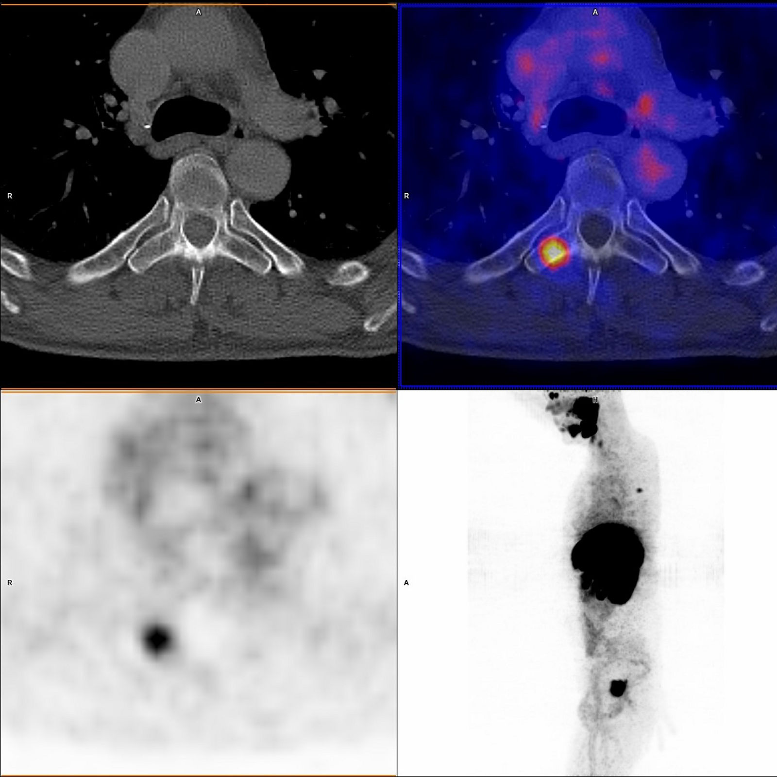 PET-CT | Helios Universitätsklinikum Wuppertal