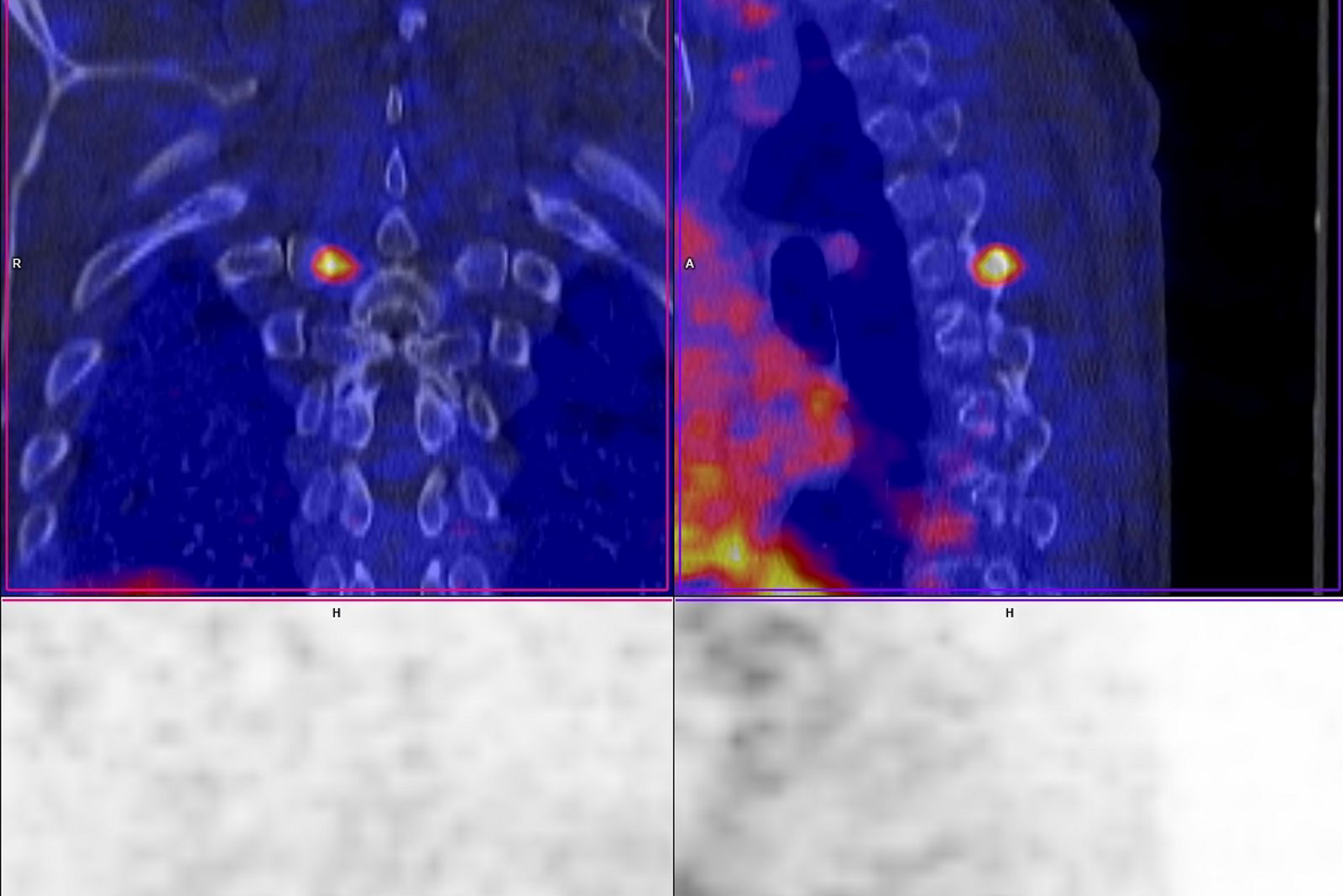PSMA Knochenmetastase Wirbelkörper Bild 2