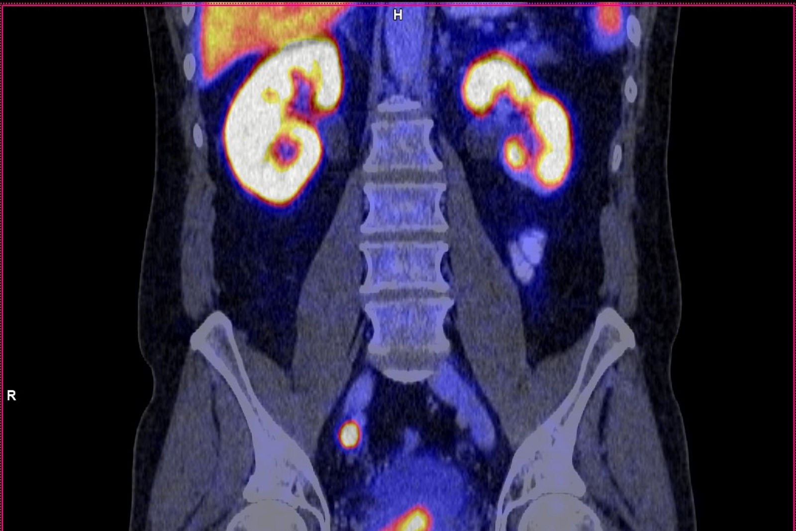 PSMA Prostatatumor Lymphknotenmetastase Bild 1