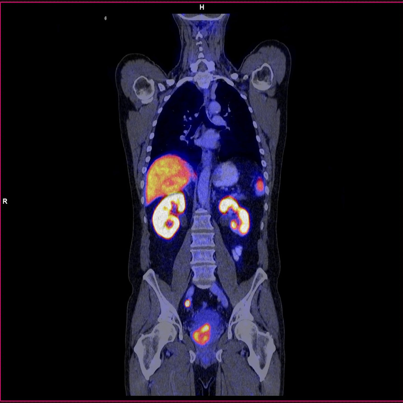 PET-CT | Helios Universitätsklinikum Wuppertal